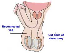 Vasectomy Reversal Success Rates Frisco, TX - Vasectomy Reversal Success Rates